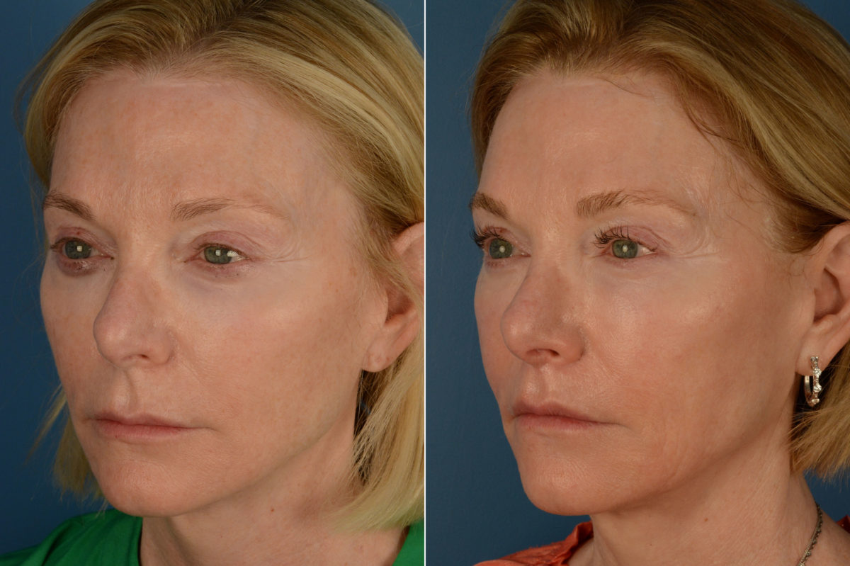 Lip Lift Before and After Photos in Naples, FL, Patient 20321