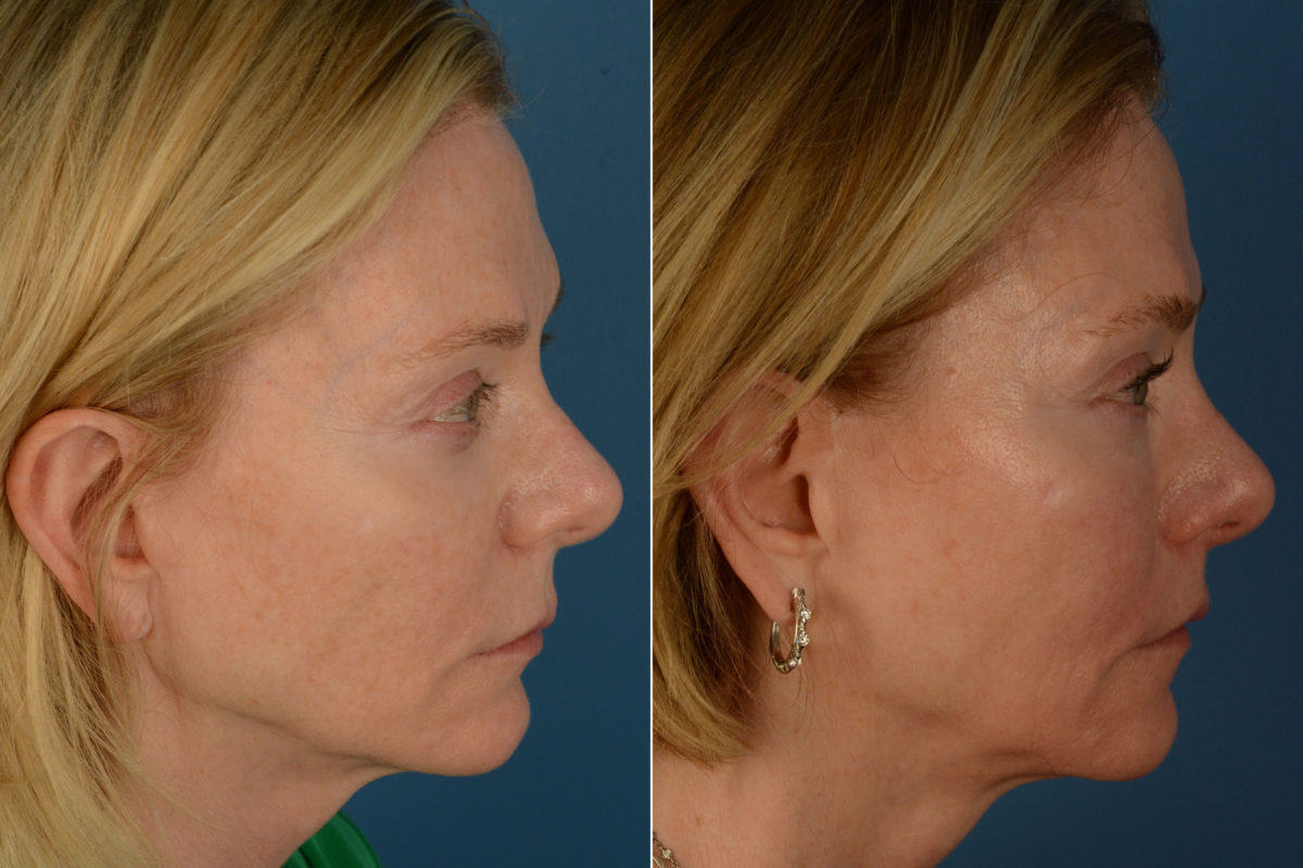Lip Lift Before and After Photos in Naples, FL, Patient 20321