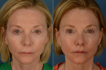 Lip Lift Before and After Photos in Naples, FL, Patient 20321