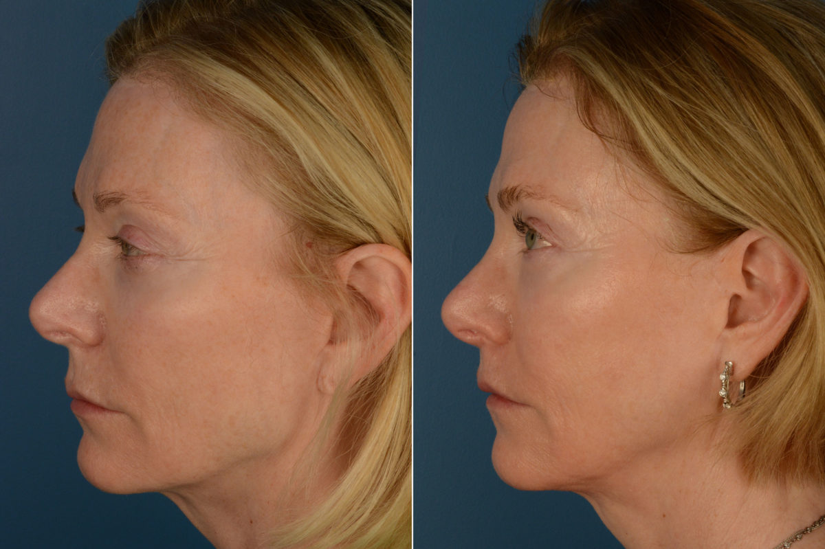 Lip Lift Before and After Photos in Naples, FL, Patient 20321