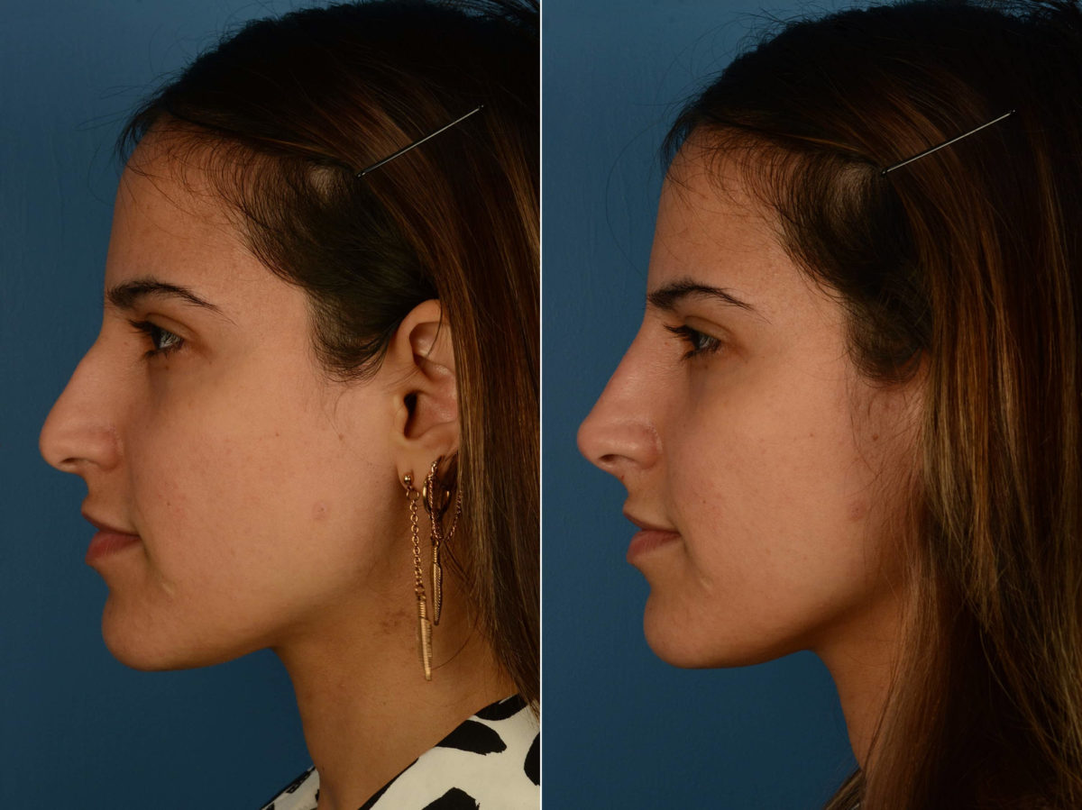 Injectable Filler Rhinoplasty Before and After Photos in Naples, FL, Patient 20347