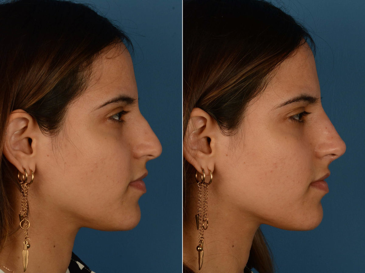 Injectable Filler Rhinoplasty Before and After Photos in Naples, FL, Patient 20347