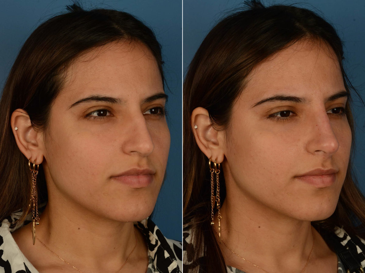 Injectable Filler Rhinoplasty Before and After Photos in Naples, FL, Patient 20347