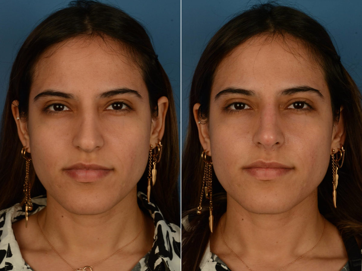 Injectable Filler Rhinoplasty Before and After Photos in Naples, FL, Patient 20347