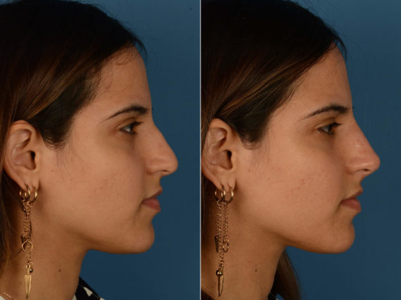 Injectable Filler Rhinoplasty Before and After Photos in Naples, FL, Patient 20347