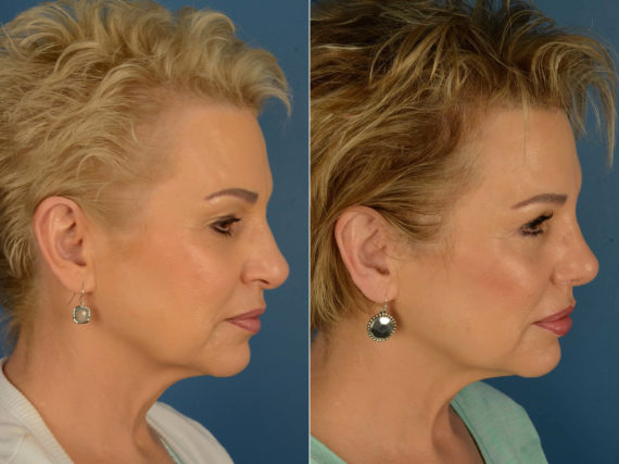 Rhinoplasty Before and After Photos in Naples, FL, Patient 20361