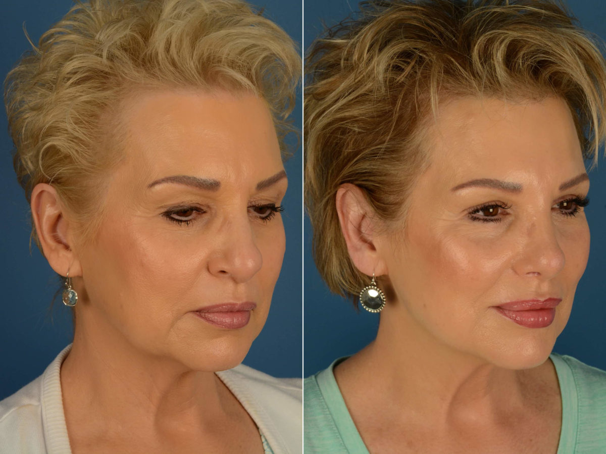 Rhinoplasty Before and After Photos in Naples, FL, Patient 20361