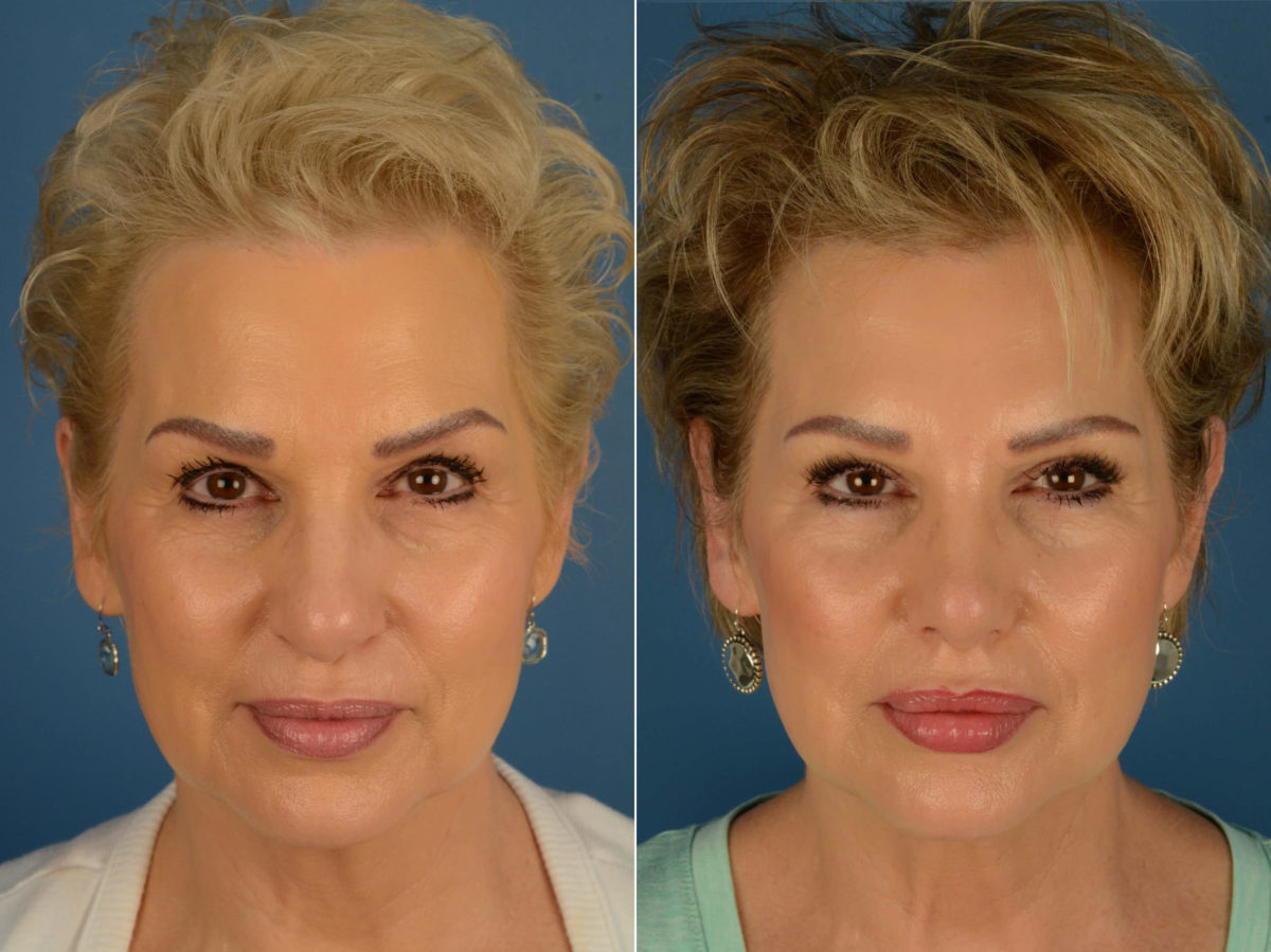 Rhinoplasty Before and After Photos in Naples, FL, Patient 20361