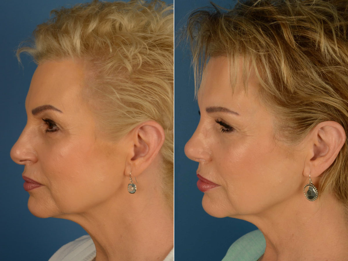 Rhinoplasty Before and After Photos in Naples, FL, Patient 20361