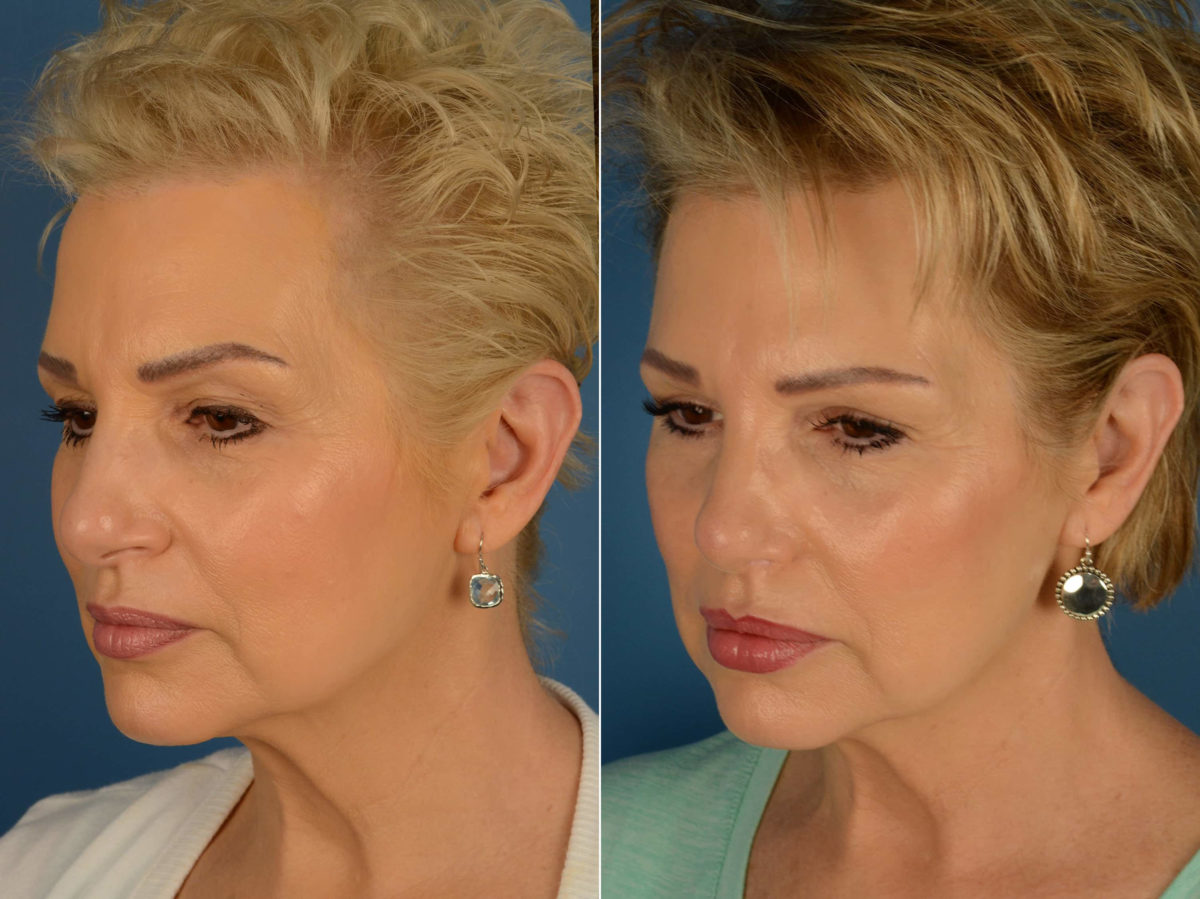 Rhinoplasty Before and After Photos in Naples, FL, Patient 20361