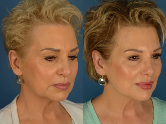 Rhinoplasty Before and After Photos in Naples, FL, Patient 20361