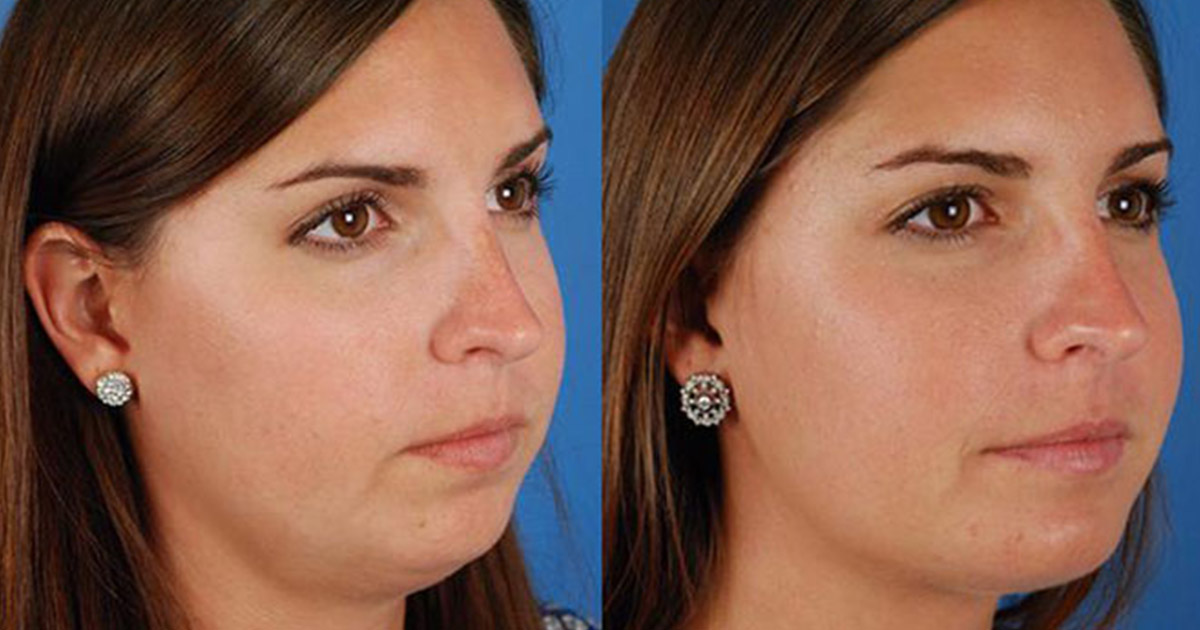 Are Cheek Implants Permanent