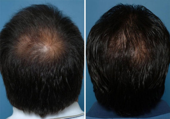 Hair Replacement Before and After Photos in Naples, FL, Patient 8546