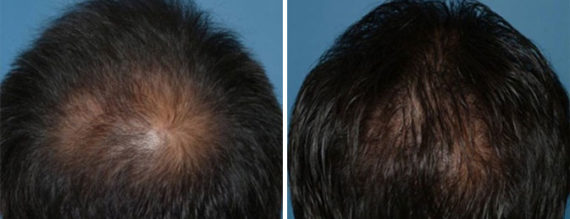 Hair Replacement Before and After Photos in Naples, FL, Patient 8546