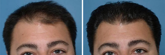 Hair Replacement Before and After Photos in Naples, FL, Patient 8546