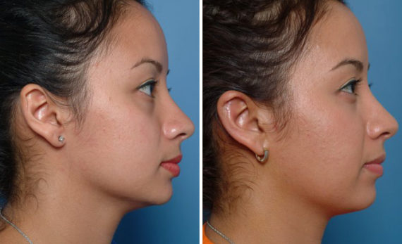 Otoplasty Before and After Photos in Naples, FL, Patient 8585