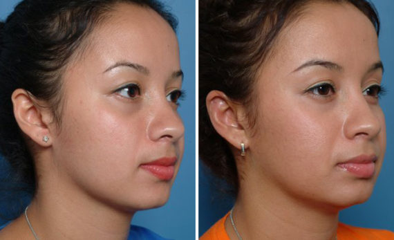 Otoplasty Before and After Photos in Naples, FL, Patient 8585