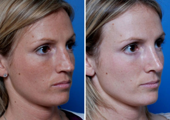 Revision Rhinoplasty Before and After Photos in Naples, FL, Patient 8600