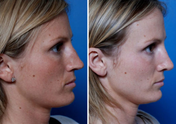 Revision Rhinoplasty Before and After Photos in Naples, FL, Patient 8600
