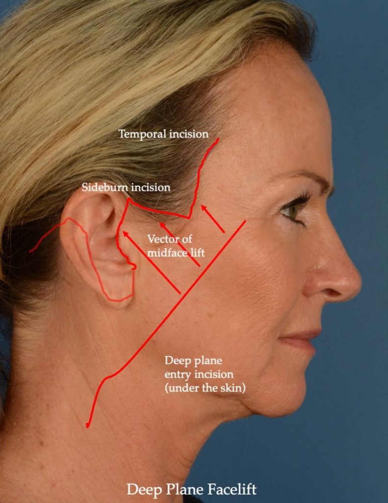 Dr. Agarwal Anurag performs Deep Plane Facelift procedure with excellent results in Naples,FL.