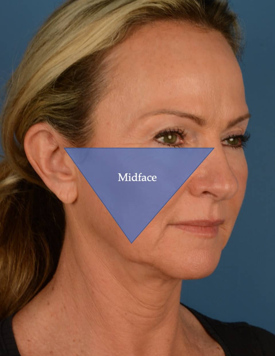 Dr. Anurag Agarwal explains the differences between Endoscopic Midface Lift, Deep Plane Facelift  and UpLift Lower Face and Neck Lift.