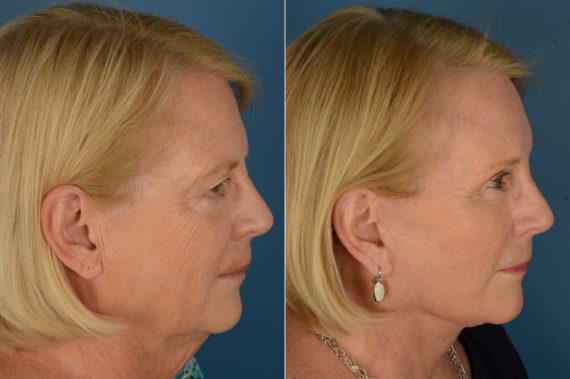 Endoscopic Facelift Before and After Photos in Naples, FL, Patient 21071