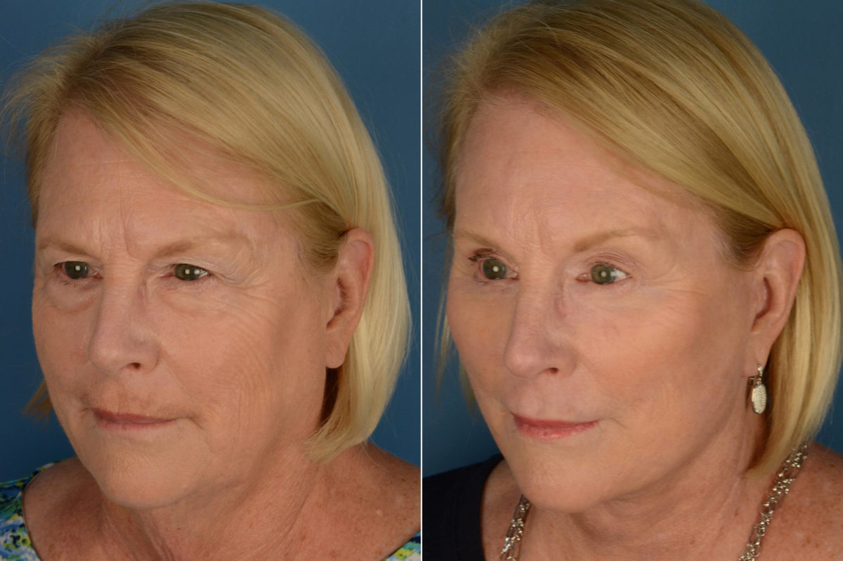 Endoscopic Facelift Before and After Photos in Naples, FL, Patient 21071