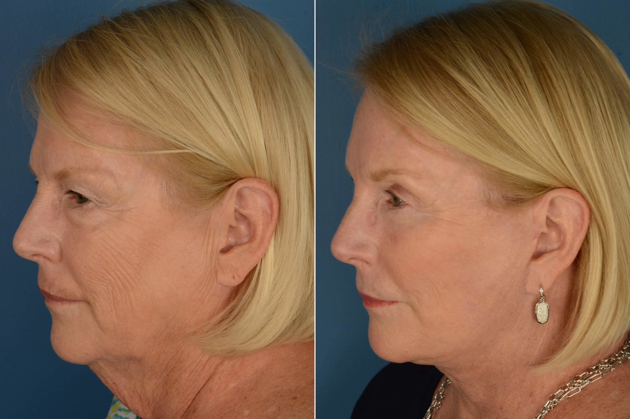 Endoscopic Facelift Photos Naples, FL Patient 21071