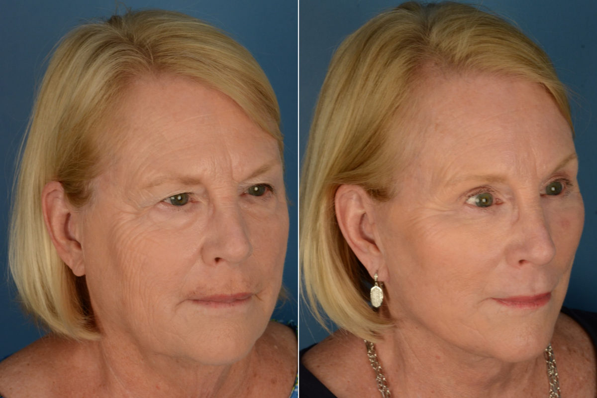 Endoscopic Facelift Before and After Photos in Naples, FL, Patient 21071