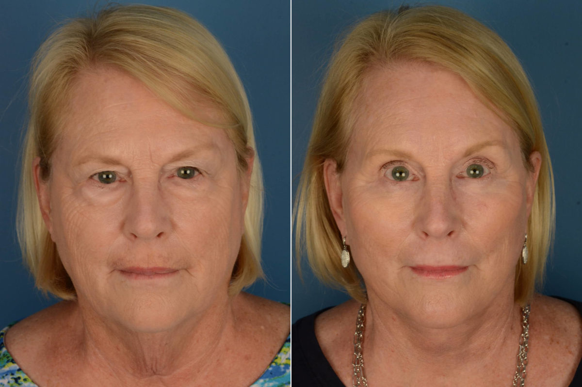 Endoscopic Facelift Before and After Photos in Naples, FL, Patient 21071