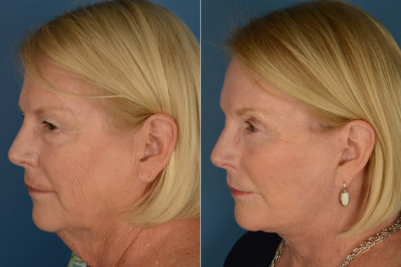 Endoscopic Facelift Before and After Photos in Naples, FL, Patient 21071