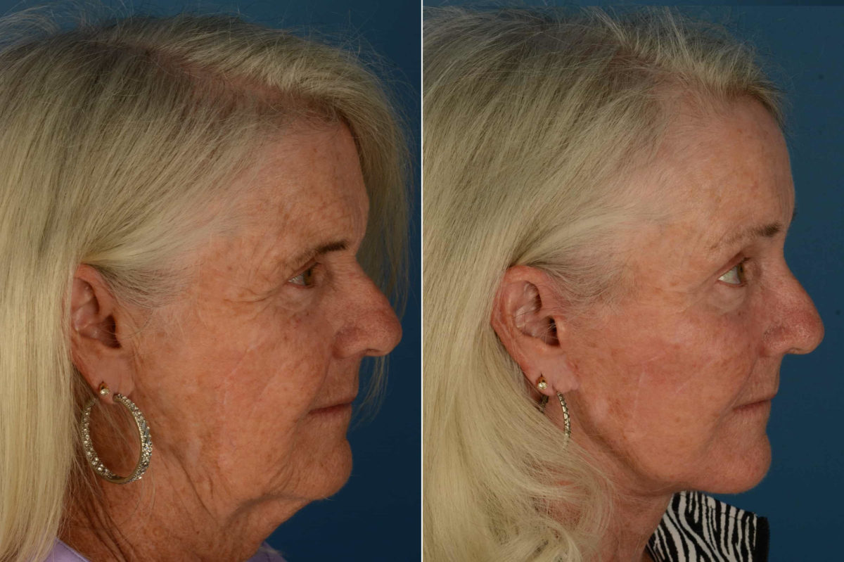Endoscopic Facelift Before and After Photos in Naples, FL, Patient 21108