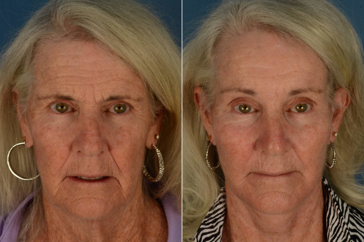 Endoscopic Facelift Before and After Photos in Naples, FL, Patient 21108
