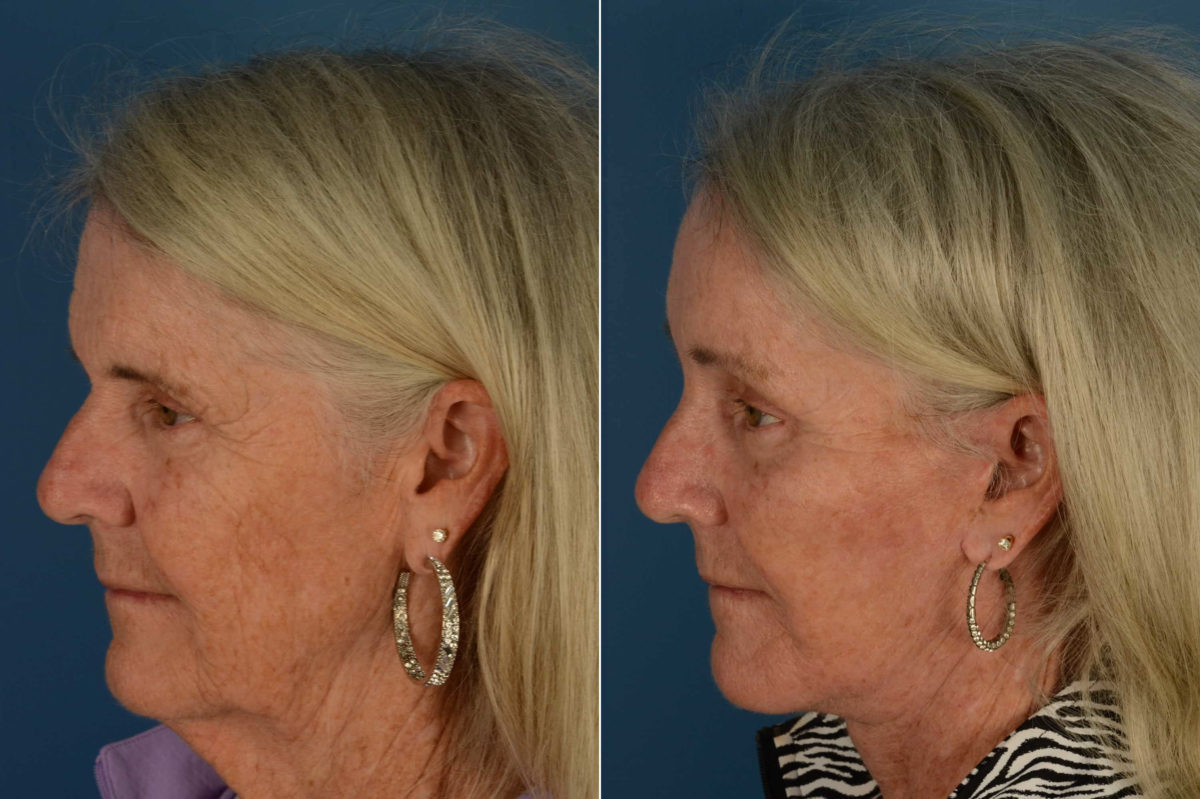 Endoscopic Facelift Before and After Photos in Naples, FL, Patient 21108