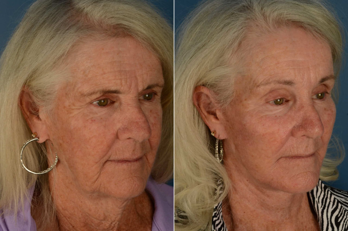 Endoscopic Facelift Before and After Photos in Naples, FL, Patient 21108