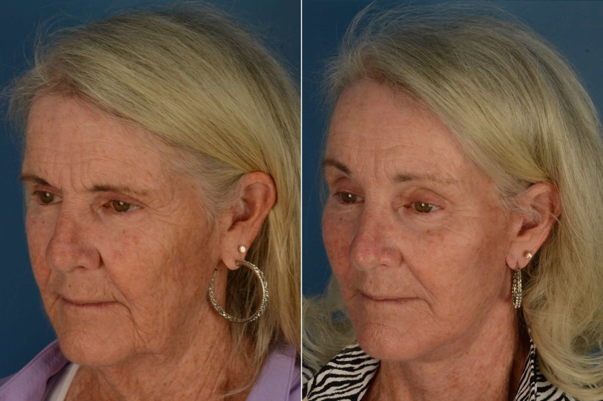 Endoscopic Facelift Before and After Photos in Naples, FL, Patient 21108