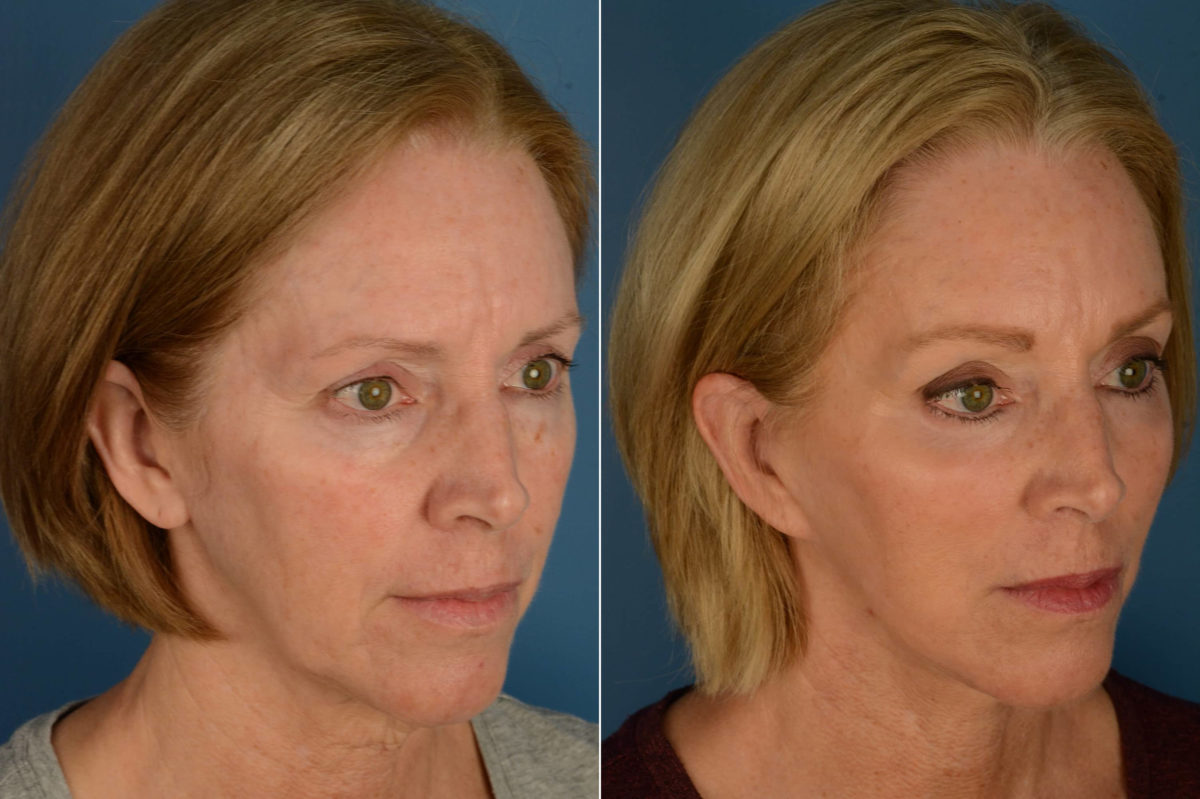 Endoscopic Facelift Before and After Photos in Naples, FL, Patient 21128