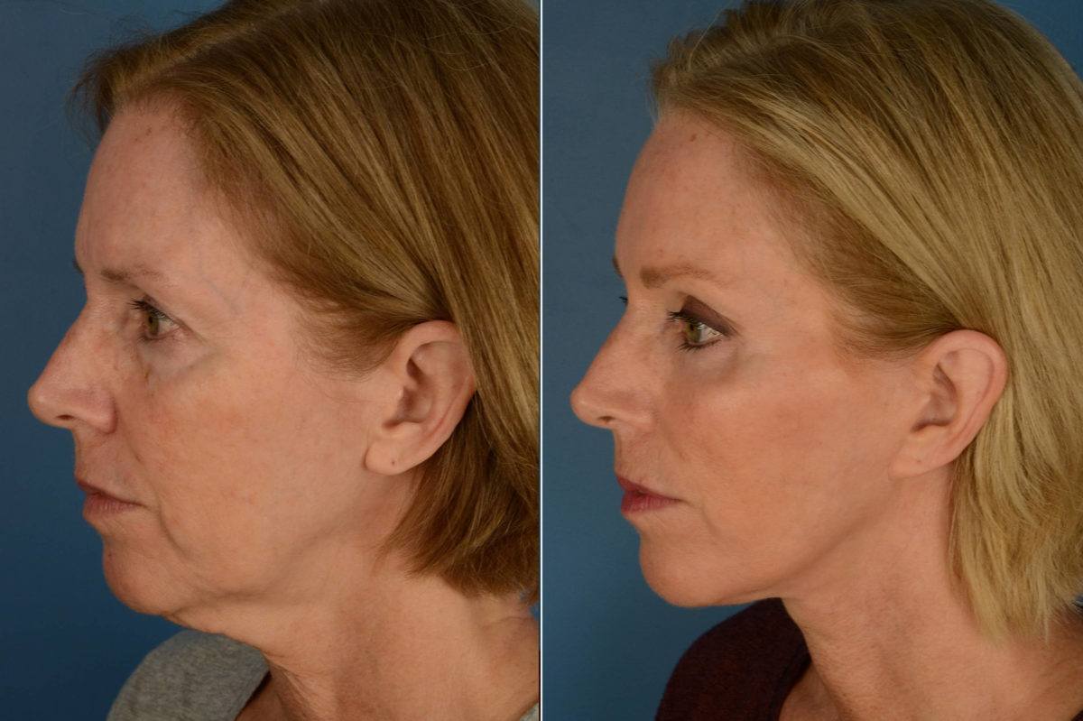 Endoscopic Facelift Before and After Photos in Naples, FL, Patient 21128