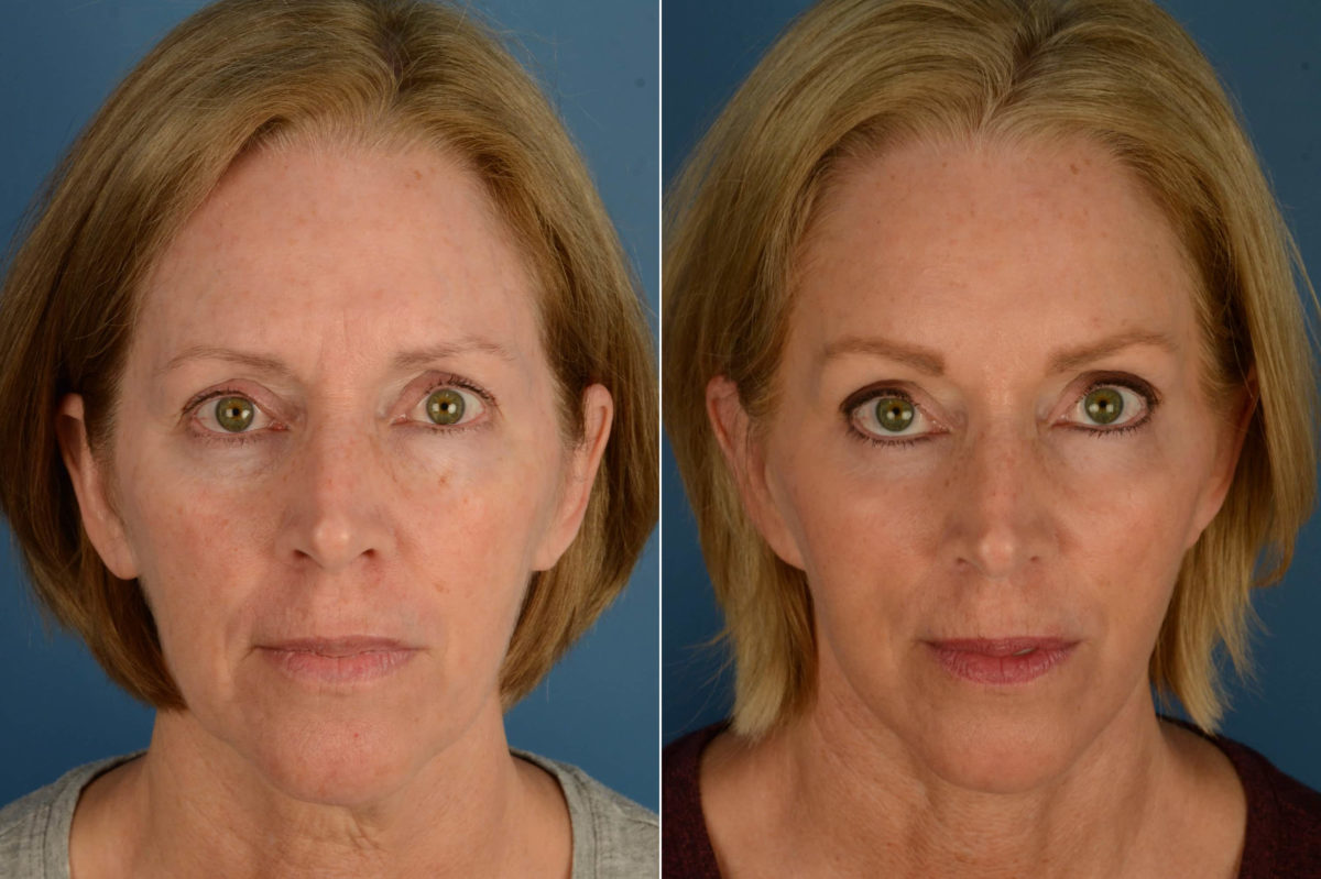 Endoscopic Facelift Before and After Photos in Naples, FL, Patient 21128