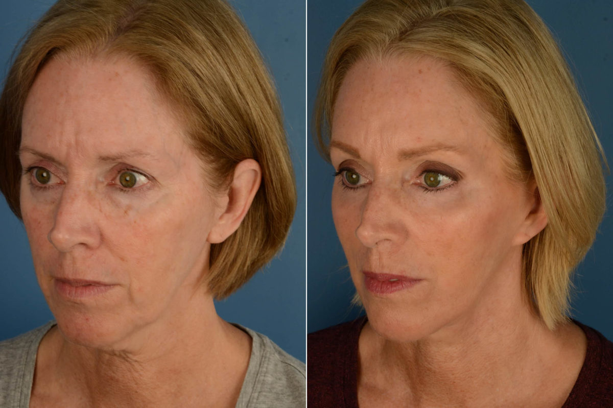 Endoscopic Facelift Before and After Photos in Naples, FL, Patient 21128