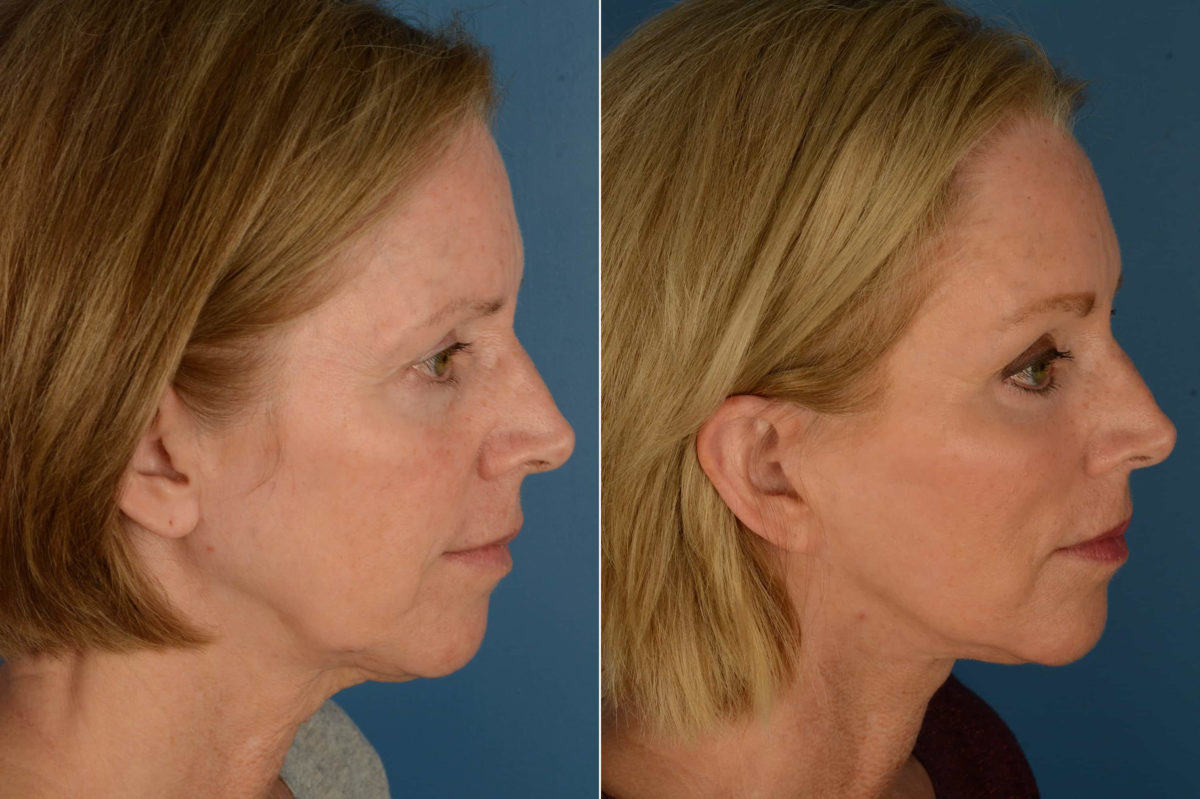 Endoscopic Facelift Before and After Photos in Naples, FL, Patient 21128