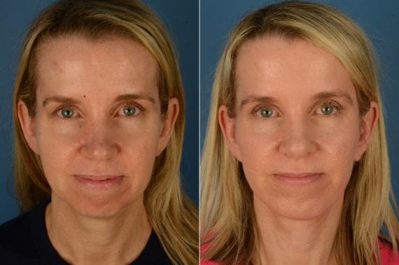 Chin Implant Before and After Photos in Naples, FL, Patient 21170