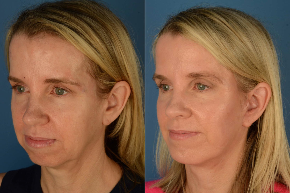 Chin Implant Before and After Photos in Naples, FL, Patient 21170