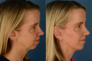 Chin Implant Before and After Photos in Naples, FL, Patient 21170