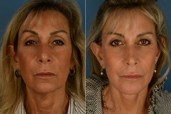 The UpLift™ Lower Face and Neck Lift Before and After Photos in Naples, FL, Patient 21192