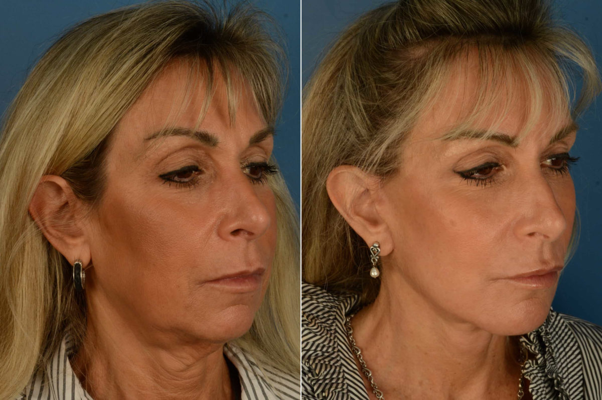 The UpLift™ Lower Face and Neck Lift Before and After Photos in Naples, FL, Patient 21192