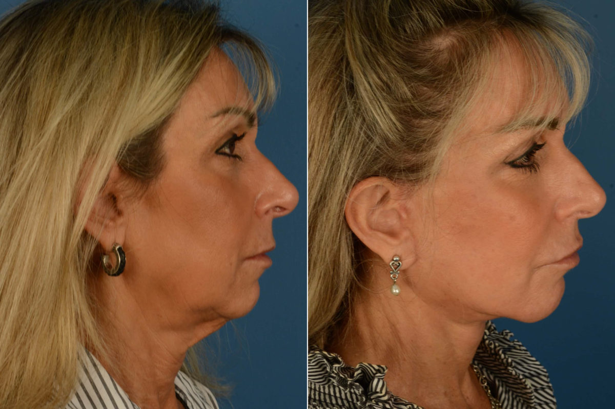 The UpLift™ Lower Face and Neck Lift Before and After Photos in Naples, FL, Patient 21192