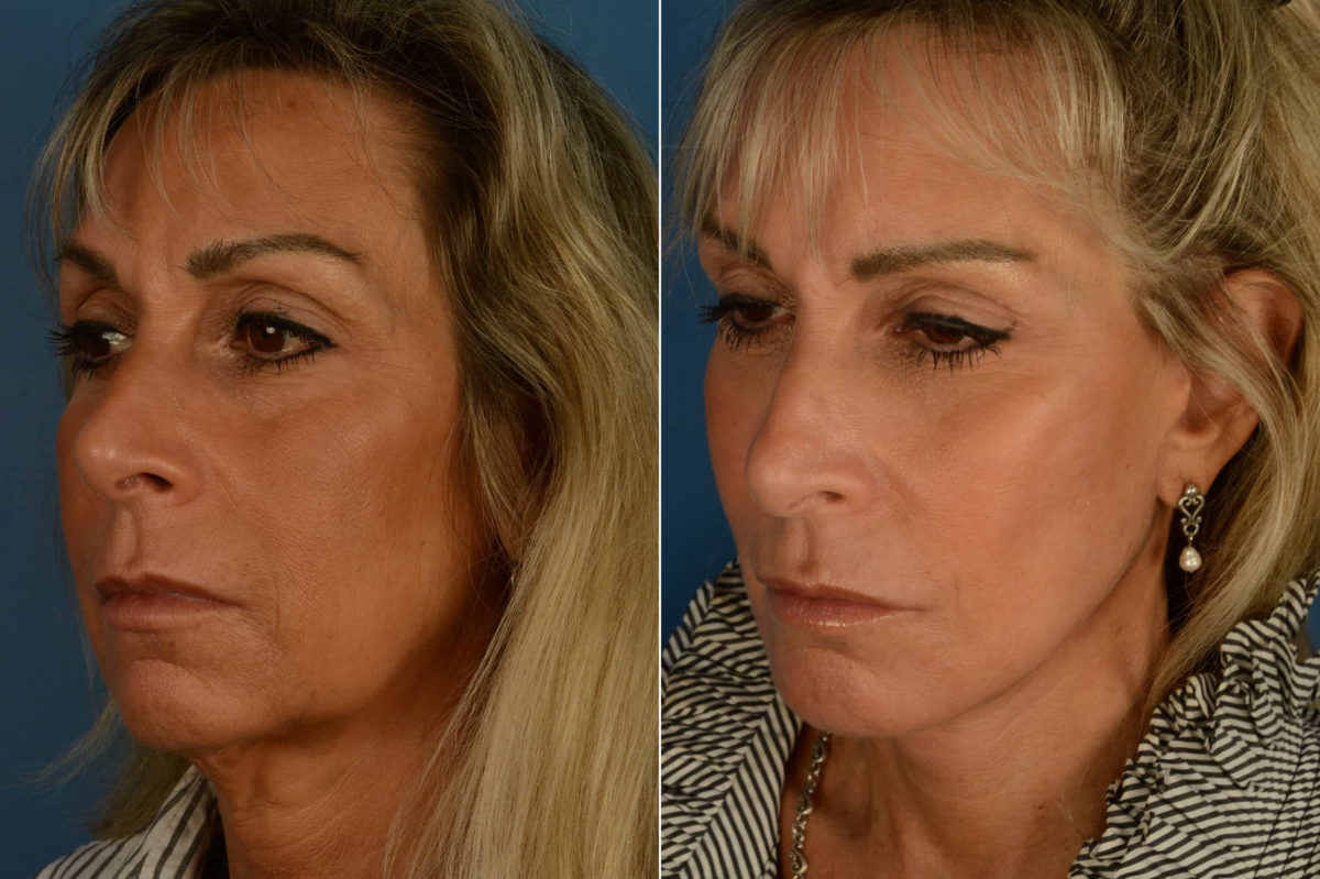 The UpLift™ Lower Face and Neck Lift Before and After Photos in Naples, FL, Patient 21192