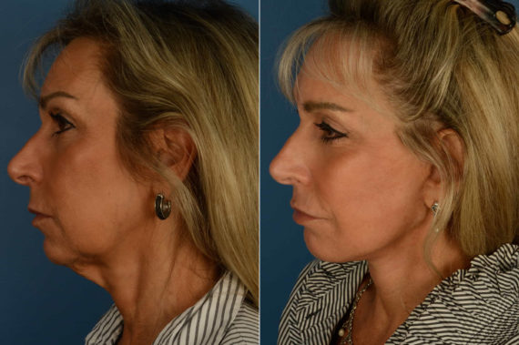 The UpLift™ Lower Face and Neck Lift Before and After Photos in Naples, FL, Patient 21192