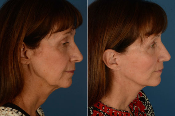 Endoscopic Facelift Before and After Photos in Naples, FL, Patient 21221